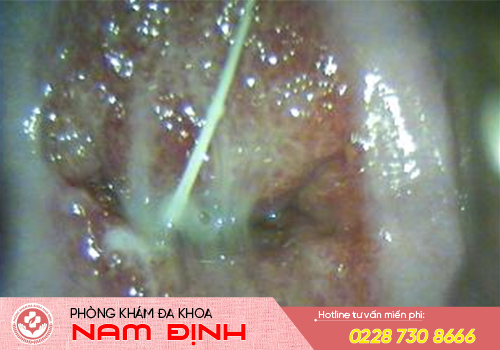 triệu chứng viêm cổ tử cung