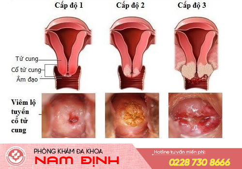 viêm lộ tuyến cổ tử cung