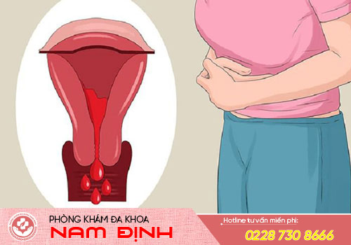 chảy máu âm đạo