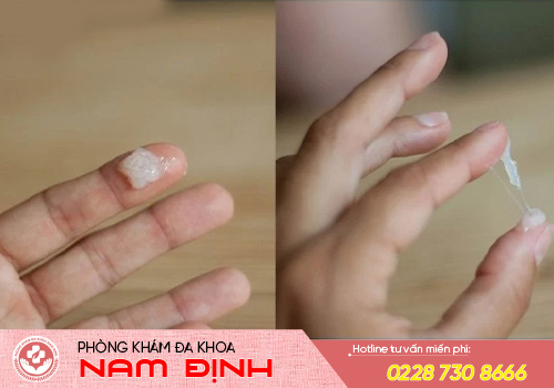 khí hư vón cục