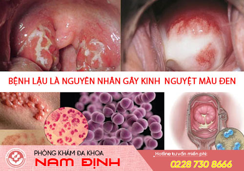 kinh nguyệt màu đen