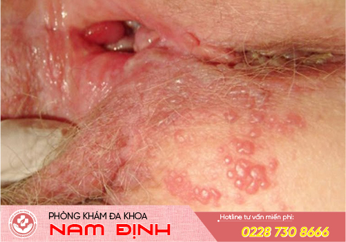 triệu chứng viêm âm đạo