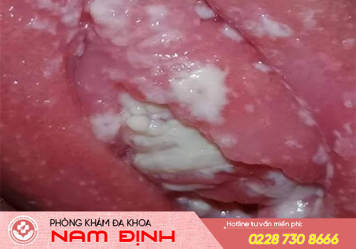 nấm vùng kín