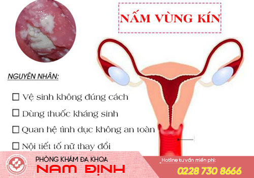 nấm vùng kín