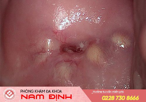 nang naboth cổ tử cung