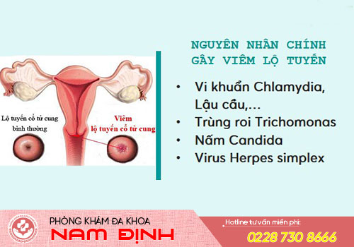 viêm lộ tuyến
