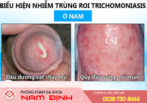 nhiễm trichomonas