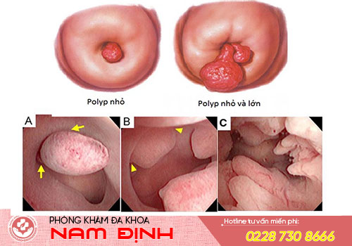 polyp tử cung