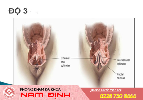 rách âm đạo
