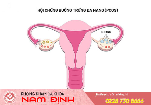 rối loạn kinh nguyệt