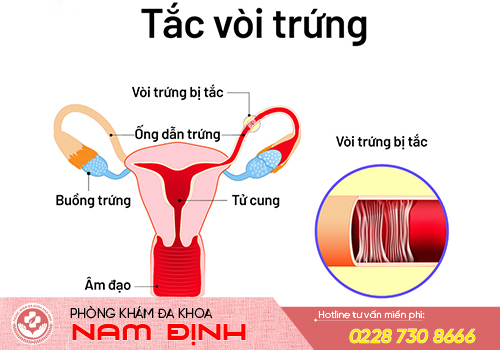 tắc vòi trứng