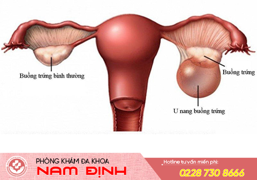 đau bụng dưới