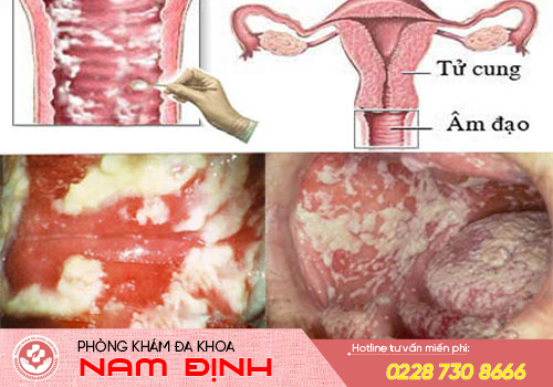 vùng kín ra dịch trắng đặc