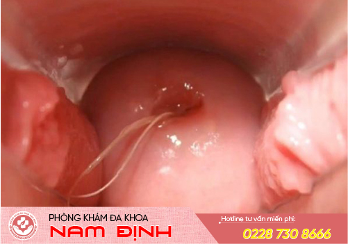thuốc chữa viêm âm đạo
