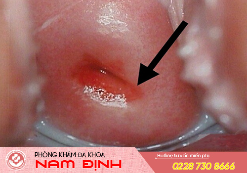 triệu chứng viêm cổ tử cung