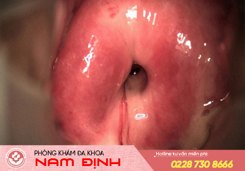viêm cổ tử cung