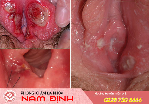 viêm loét vùng kín âm đạo