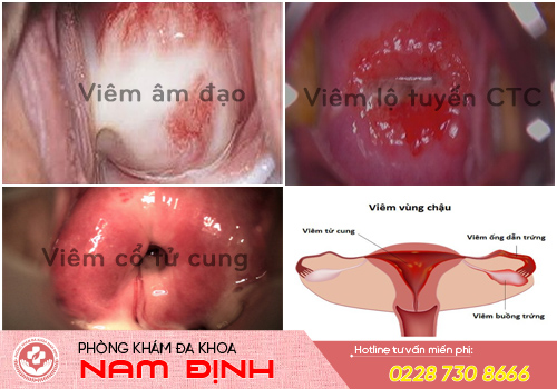 khí hư có mùi hôi