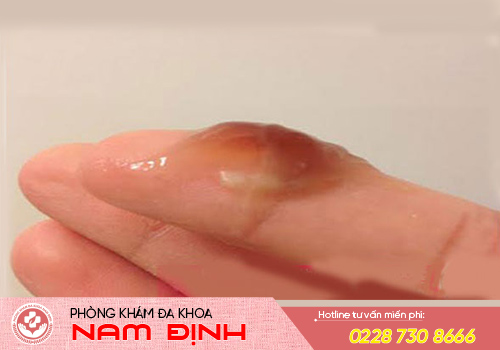 vúng kín ra dịch nâu